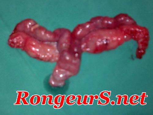 Tumeur de l'uterus de la lapine (adenocarcinome)
