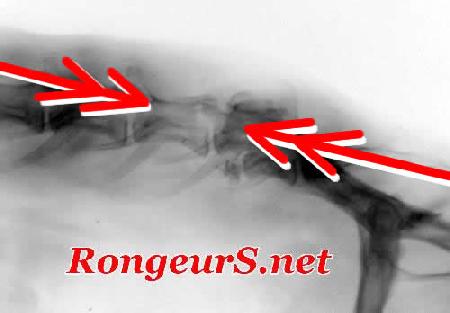 Neuro: paralysie paraplégie Téléscopage vertebral 
